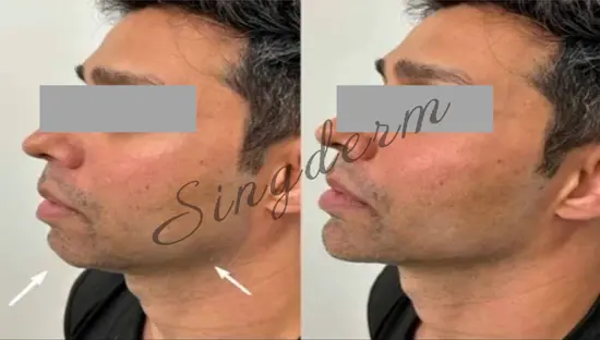 Singderm Jawline Refining Before & After