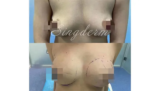Singderm Breast Enlargement
