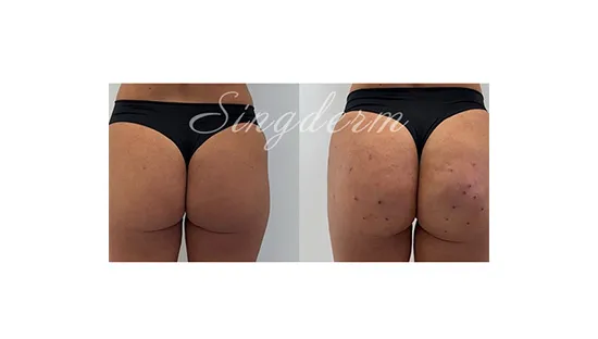 Singderm Buttock Enhancement