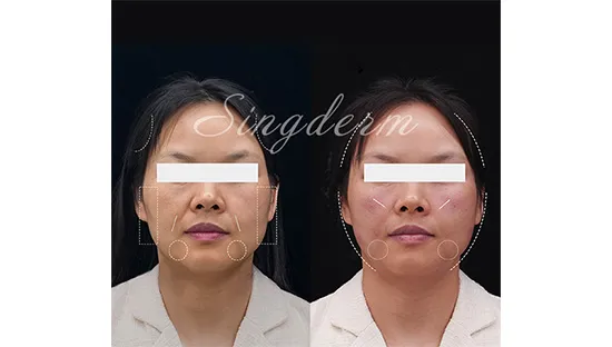Singderm Midface Injection